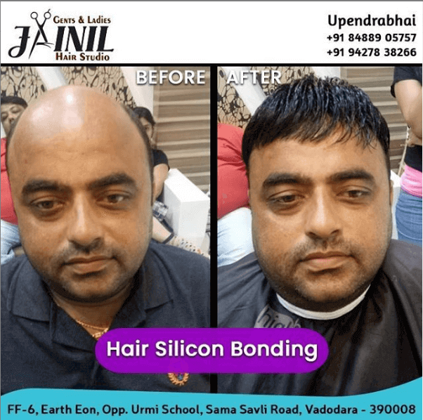 Hair Transplant Price in AhmedabadGujarat
