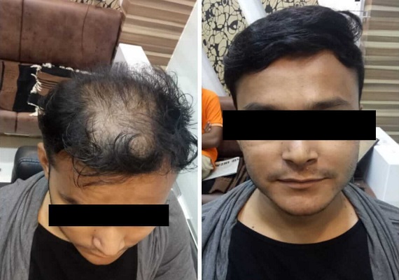 hair treatment in vadodara